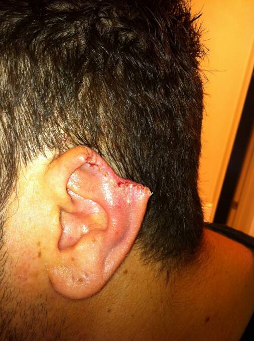 This Canberra man lost part of his ear after it was bitten in a Dickson nightspot. Photo: Supplied