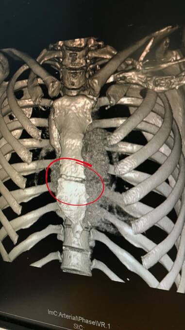 Caroline Buchanan has had surgery to repair the crack in her sternum. Photo: Supplied