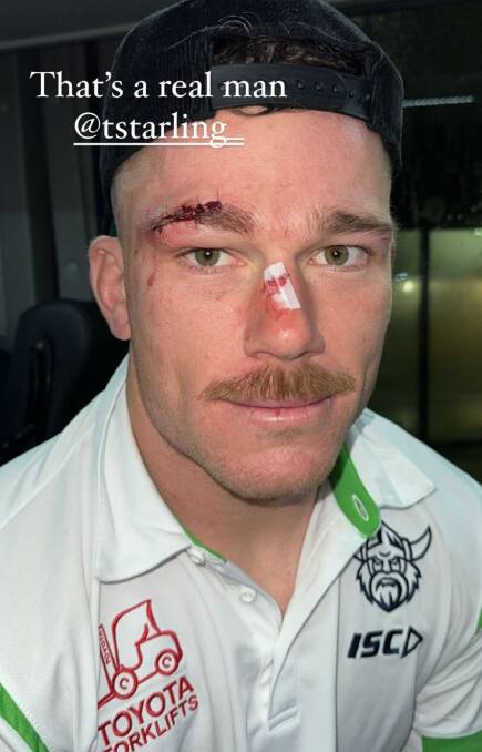 Tom Starling received stitches after suffering a head gash. Picture Instagram