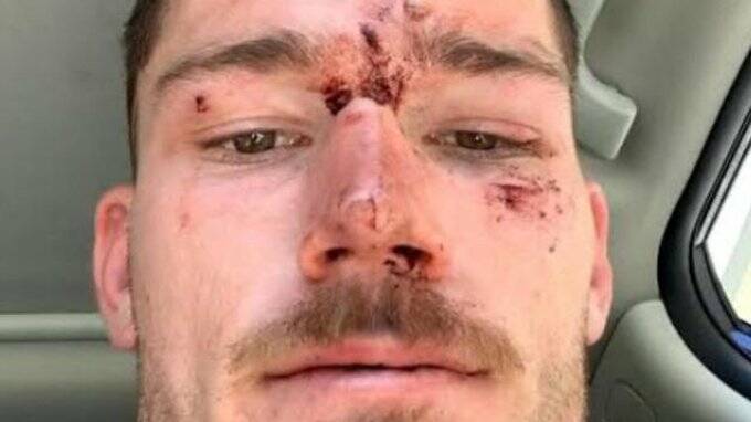 Tom Starling after the nightclub brawl. Picture Supplied
