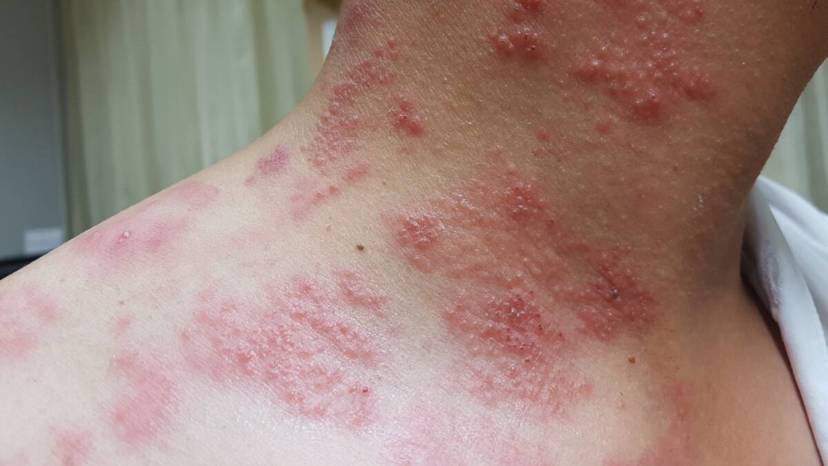 An adult infected with shingles would be experience painful red rashes. Picture Shutterstock
