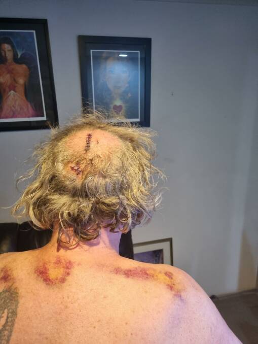 The wounds to the public housing tenant's shoulders, back and head after the home invasion in late July. Picture supplied 