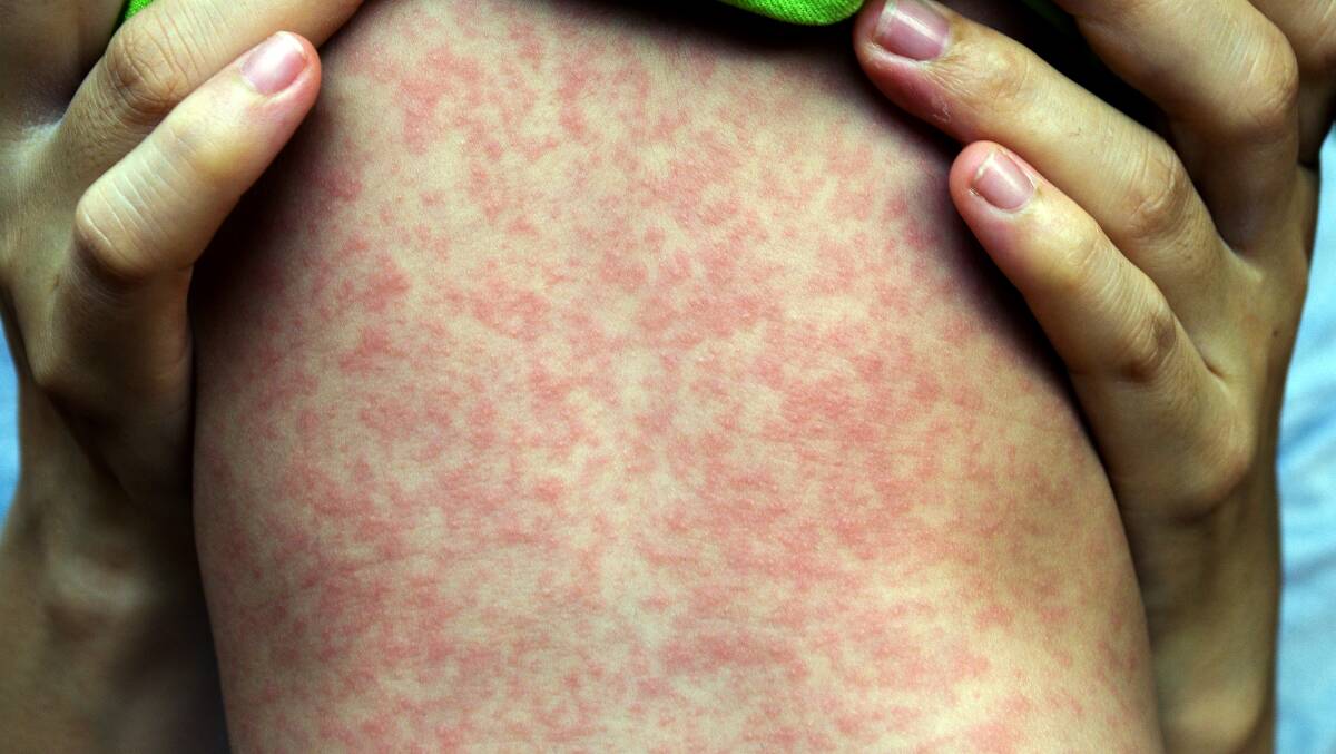 Measles rash. Picture Shutterstock