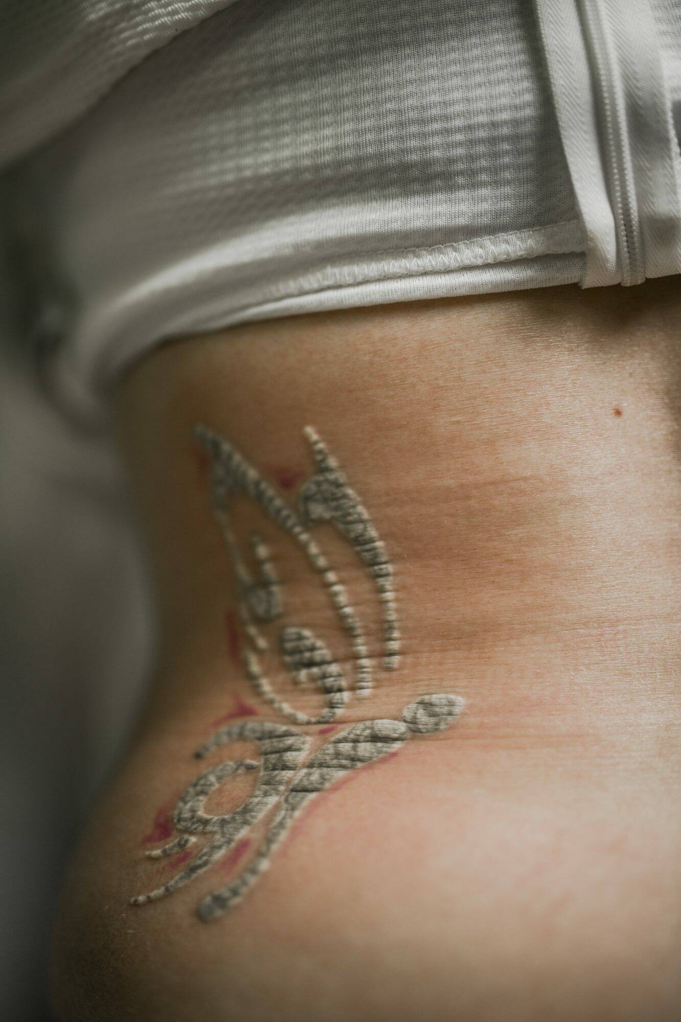 Tattoo Removal on Up to 10cm x 10cm Area at ReNew Skin  ReNew Skin   Groupon