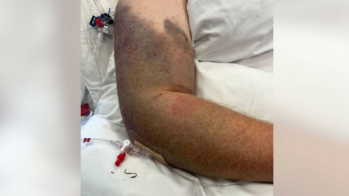 Bruises to the arm of Luke Briggs, who died in a Melbourne hospital after being arrested by police. (HANDOUT/BRIGGS FAMILY)